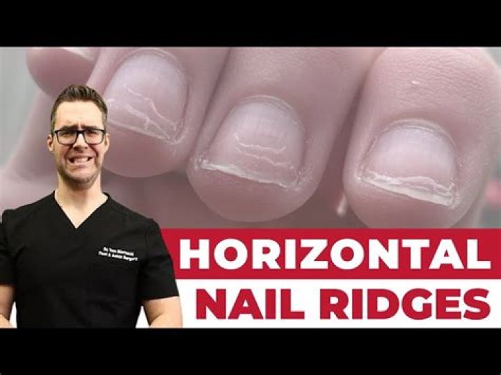 Discover The Meaning Behind Horizontal Nail Ridges: A Guide To Nail Health