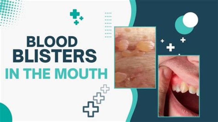 Discover The Root Causes Of Blood Blisters In Your Mouth