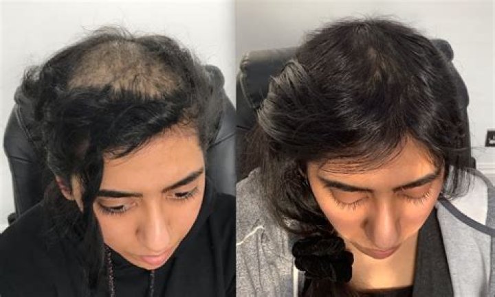 Felicia Of Big Brother Opens Up About Hair Loss Journey