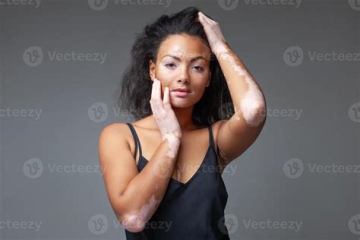 Top Vitiligo Model [vitiligo Model Name] | Inspiring Beauty